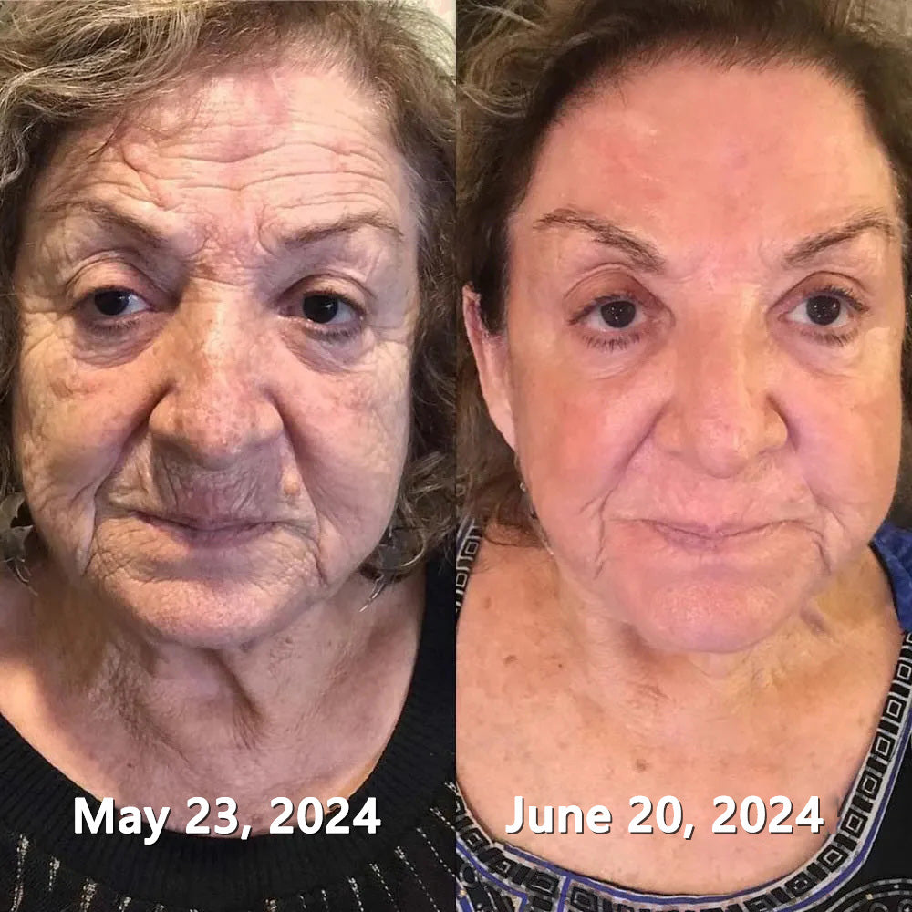 ❄𝐕𝒾𝐭𝐚𝐥𝐢𝐬𝐲𝐬® 𝖡e𝖾 V𝖾nom & PDRN Anti-Aging Firming Cream | Lifts, Tightens & Smooths Skin | Reduces Wrinkles & Fine Lines | Restores Youthful Elasticity | Powerful Bee Venom Formula 🔥🔥