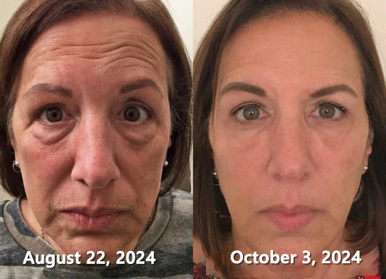 30% OFF🎁🎁𝐕𝒾𝐭𝐚𝐥𝐢𝐬𝐲𝐬® 𝖡e𝖾 V𝖾nom & PDRN Anti-Aging Firming Cream | Lifts, Tightens & Smooths Skin | Reduces Wrinkles & Fine Lines | Restores Youthful Elasticity | Powerful Bee Venom Formula 🔥🔥