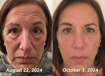 30% OFF🎁🎁𝐕𝒾𝐭𝐚𝐥𝐢𝐬𝐲𝐬® 𝖡e𝖾 V𝖾nom & PDRN Anti-Aging Firming Cream | Lifts, Tightens & Smooths Skin | Reduces Wrinkles & Fine Lines | Restores Youthful Elasticity | Powerful Bee Venom Formula 🔥🔥