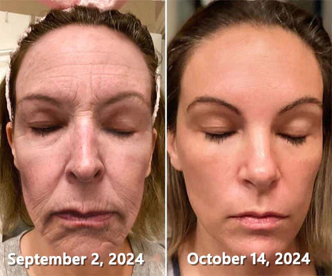 30% OFF🎁🎁𝐕𝒾𝐭𝐚𝐥𝐢𝐬𝐲𝐬® 𝖡e𝖾 V𝖾nom & PDRN Anti-Aging Firming Cream | Lifts, Tightens & Smooths Skin | Reduces Wrinkles & Fine Lines | Restores Youthful Elasticity | Powerful Bee Venom Formula 🔥🔥