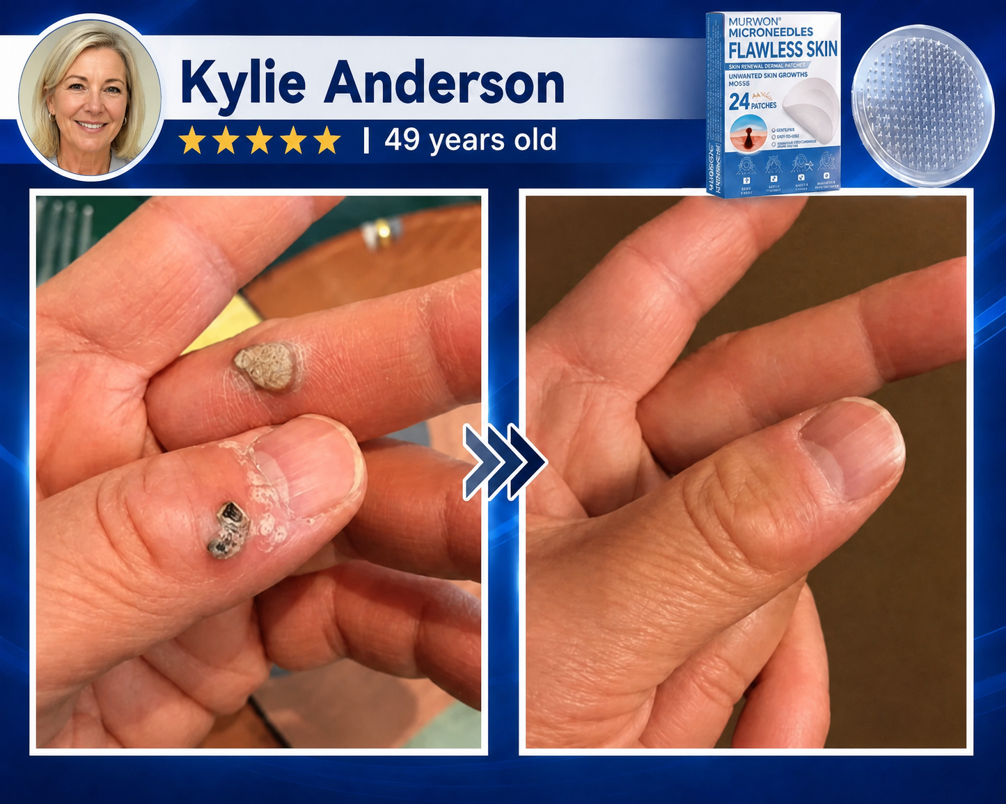👩‍⚕️💯 𝗢𝗳𝗳𝗶𝗰𝗶𝗮𝗹 𝙎𝙩𝙤𝙧𝙚 | 𝑴𝑼𝑹𝑾𝑶𝑵® 🌿 𝑴𝒊𝒄𝒓𝒐𝒏𝒆𝒆𝒅𝒍𝒆 𝑭𝒍𝒂𝒘𝒍𝒆𝒔𝒔 𝑺𝒌𝒊𝒏 & 𝑾𝒂𝒓𝒕 𝑹𝒆𝒎𝒐𝒗𝒂𝒍 𝑷𝒂𝒕𝒄𝒉 (𝑭𝒐𝒓 𝒔𝒌𝒊𝒏 𝒕𝒂𝒈𝒔, 𝒔𝒌𝒊𝒏 𝒈𝒓𝒐𝒘𝒕𝒉𝒔, 𝒘𝒂𝒓𝒕𝒔, 𝒎𝒐𝒍𝒆𝒔, 𝒔𝒖𝒏 𝒔𝒑𝒐𝒕𝒔 & 𝒑𝒊𝒈𝒎𝒆𝒏𝒕𝒂𝒕𝒊𝒐𝒏)🪷